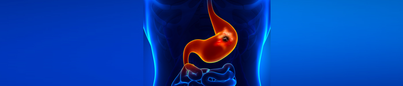 ulcers in stomach